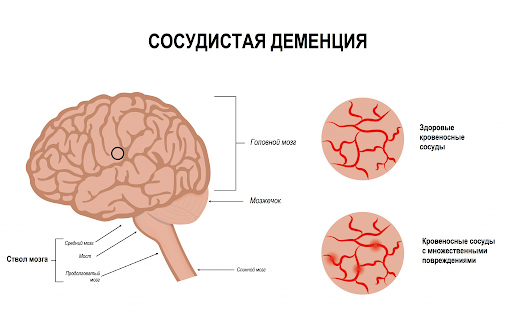 сосудистая деменция сосудистая деменция