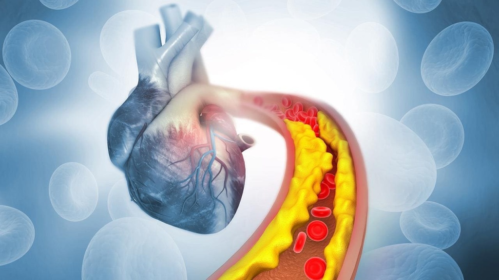 Инфаркт, хромота и атеросклероз: как стресс влияет на сердце и сосуды